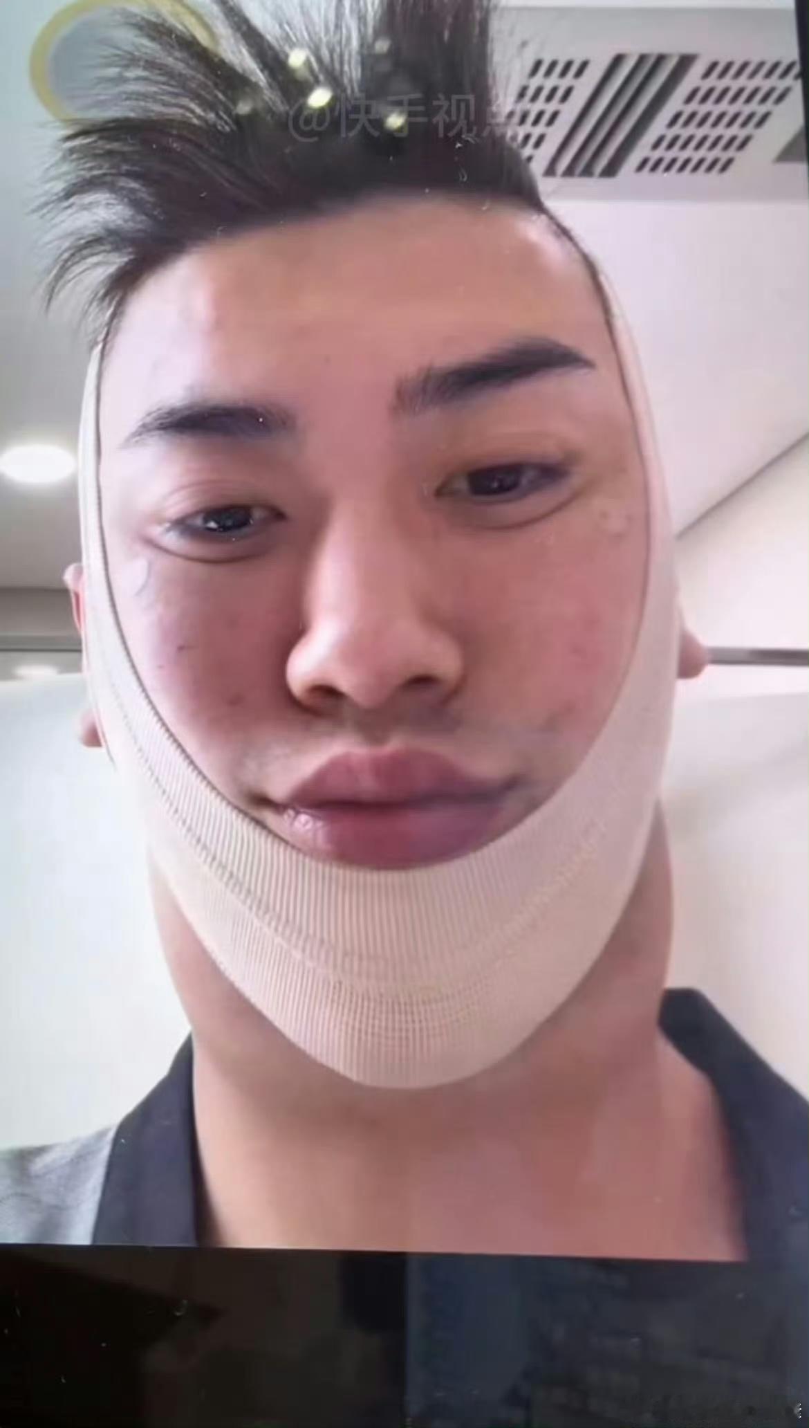 任权晒do脸照任权晒整容照笑不活了！薛小婉老公任权晒出刚做完下颚线的do脸照片，