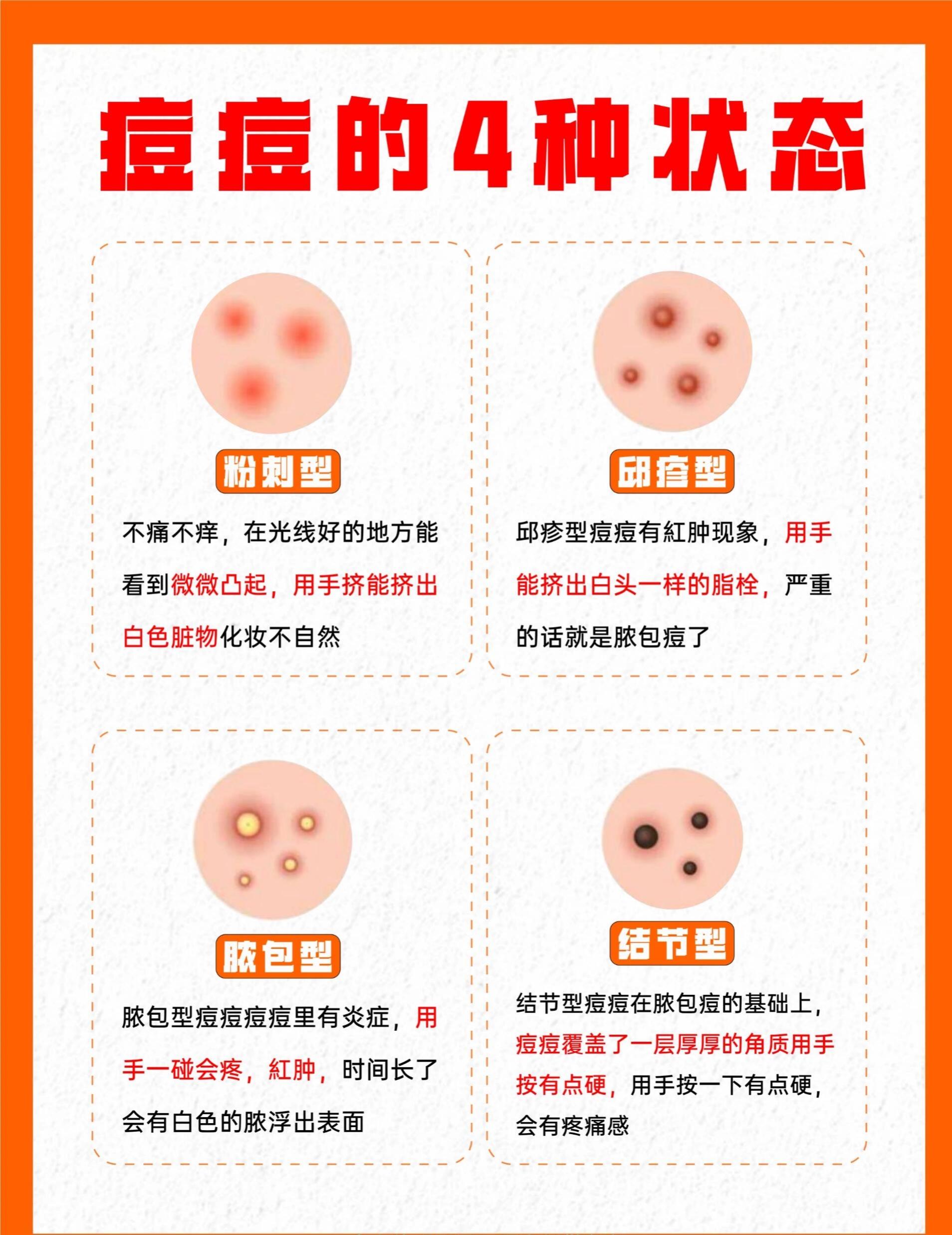 4种痘痘类型科普!对症护理才能有效战痘。粉刺闭口痘痘痘痘类型