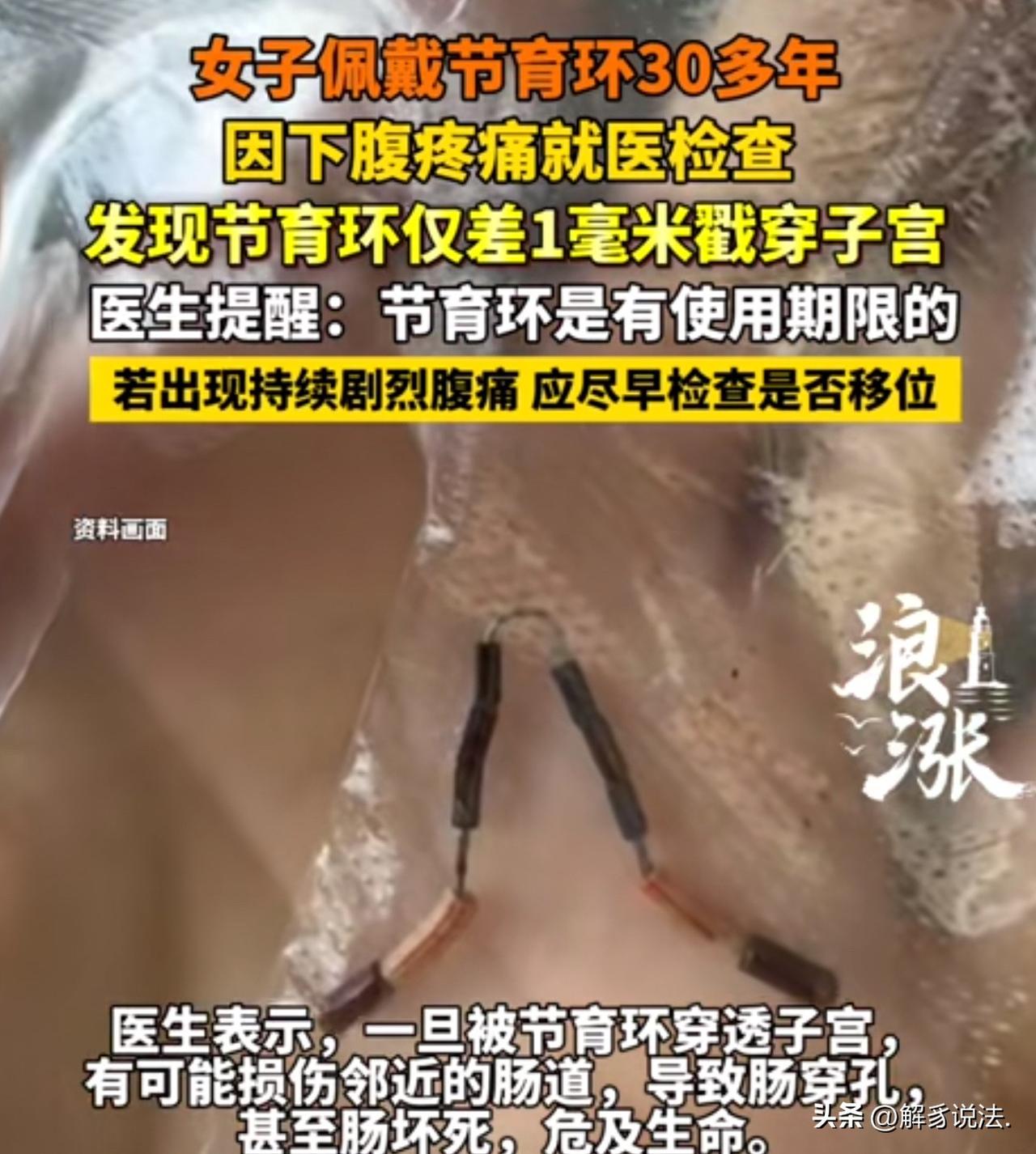 陕西西安，女子突然小腹疼痛，到医院一查，发现，她戴了30多年的节育环导致的，医生