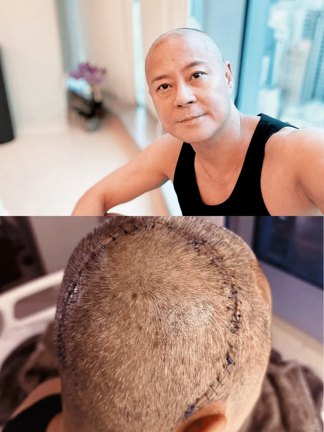 蔡一杰完成脑瘤手术报平安！头顶缝百针花近百万 	 今年8月，草蜢在佛山...