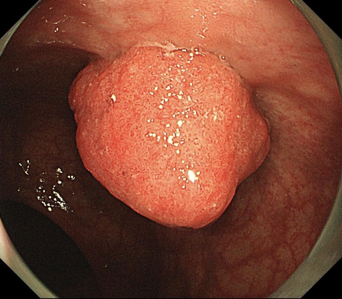 低位早期直肠Ca.男，37岁，大便带血1月，距齿状线2cm，ESD切除...