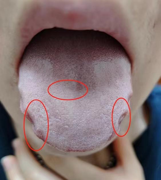 今年舌苔白腻的情况比较多
发现今年的患者寒湿都是比较重的
一看这舌苔，舌头胖胖的