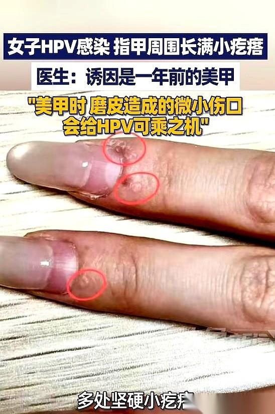 杭州一个姑娘，就因为一年前做了次美甲，手上长满了疙瘩。
她一开始还以为是死皮，拿