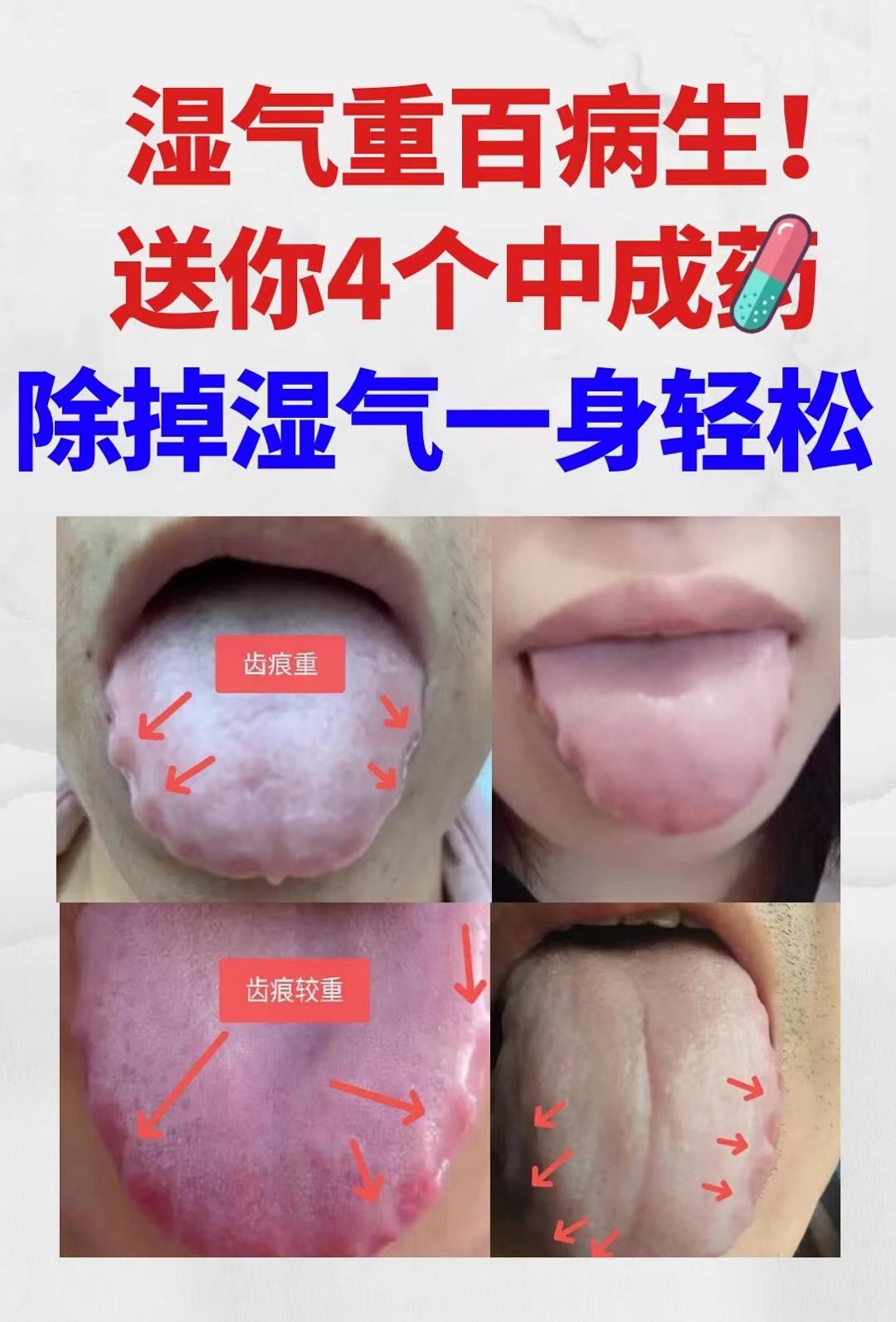 湿气一重，百病缠身生！认清楚4个舌象，中医教你精准祛湿
该怎么判断自己湿气重不重