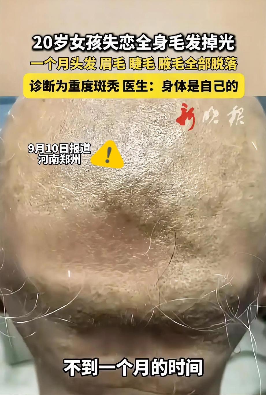 20岁姑娘为情所伤掉光头发？

别让一段错的感情，毁了本该闪光的人生！
 
郑州