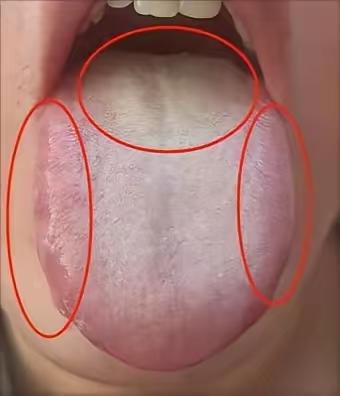 一、核心舌象：病机的直观体现
患者舌象呈现三大关键特征，每一处都对应着体内的病理