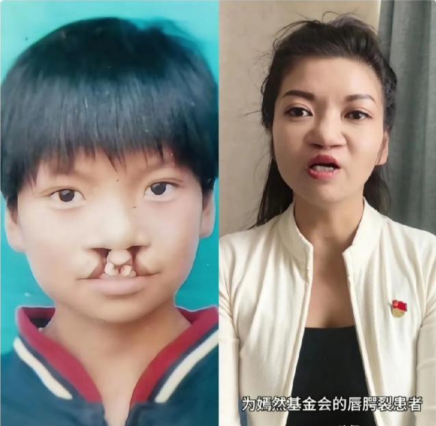 大家发现了没有，为什么那7000例免费治疗唇腭裂患者，很少有人站出来，帮李亚鹏发