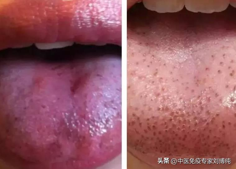舌色发紫、舌苔腻？身体在提示我们！避免包块、囊肿发生
大家好，我是中医刘博纯！
