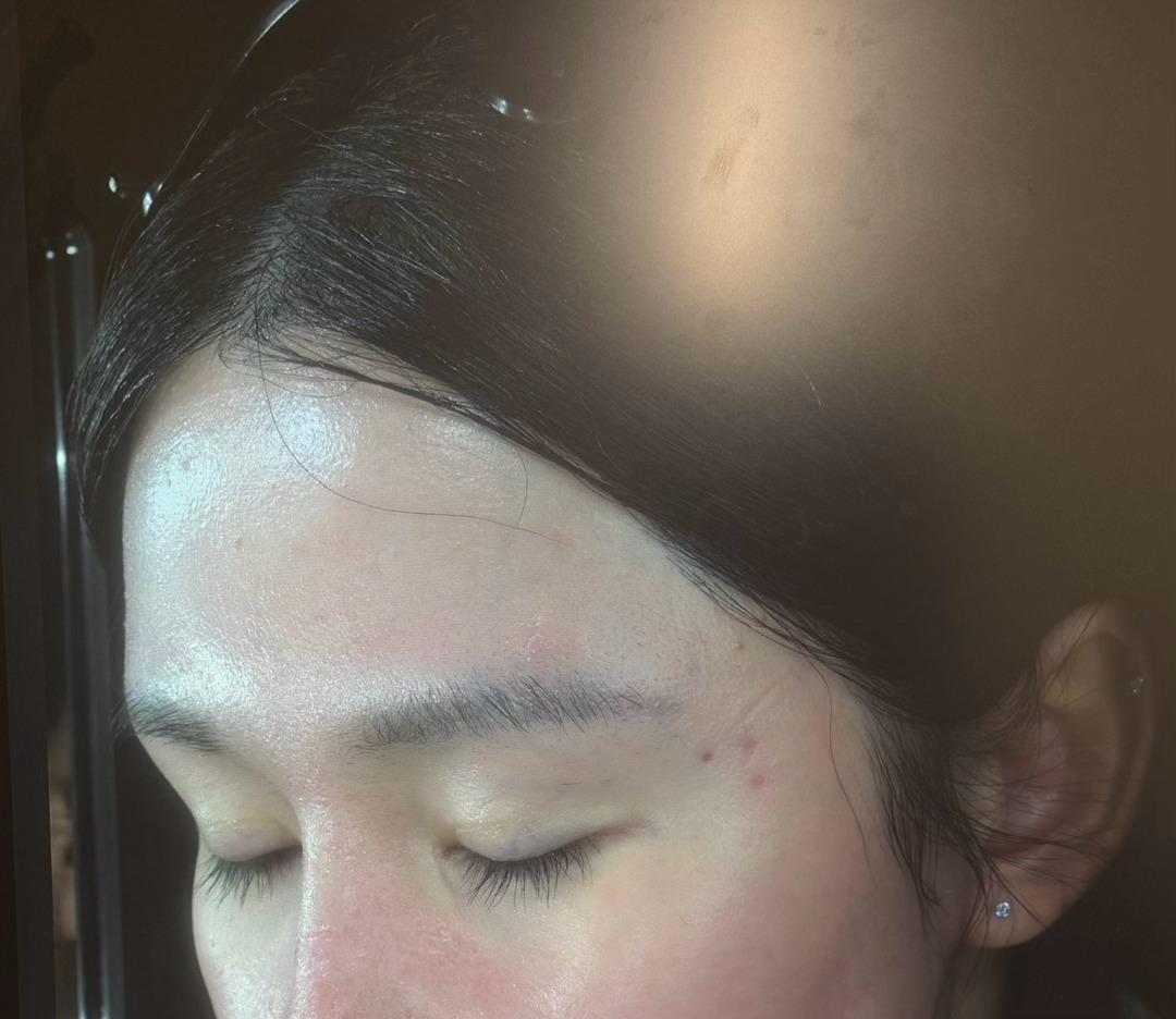 打黄金微针之前拍的皮测，瑞德喜打眉心眉弓半年后的生长情况也挺喜人的，我感觉我可能