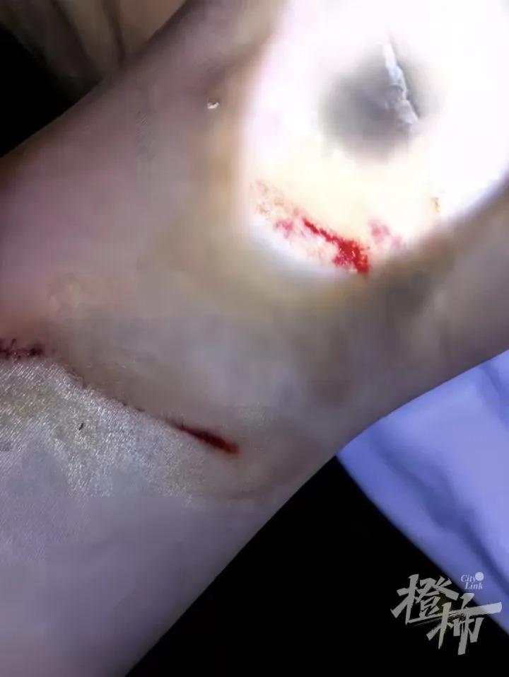姑娘爬黄山，被猴子围攻，事后打了八针疫苗！难道对这些无法无天的猴子，我们真的没有