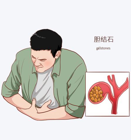 右上腹不适，可能是胆结石在 “报警”，这 6 个部位异常要留心，警惕胆道问题！