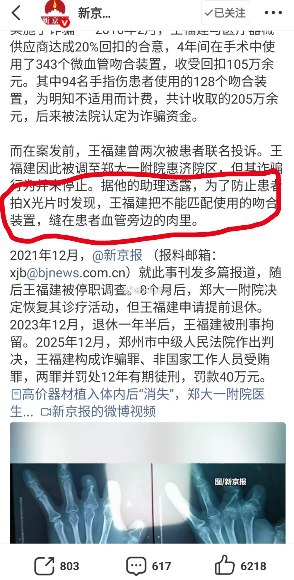 郑大一附院医生诈骗94名患者获刑为了防止患者拍X光片时发现，王福建把不能匹配使用