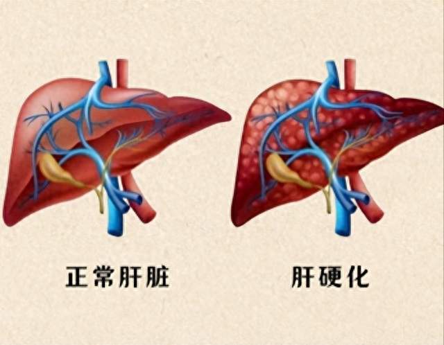 确诊肝硬化，还能活多久？给你说实话，答案或许比你想象中乐观