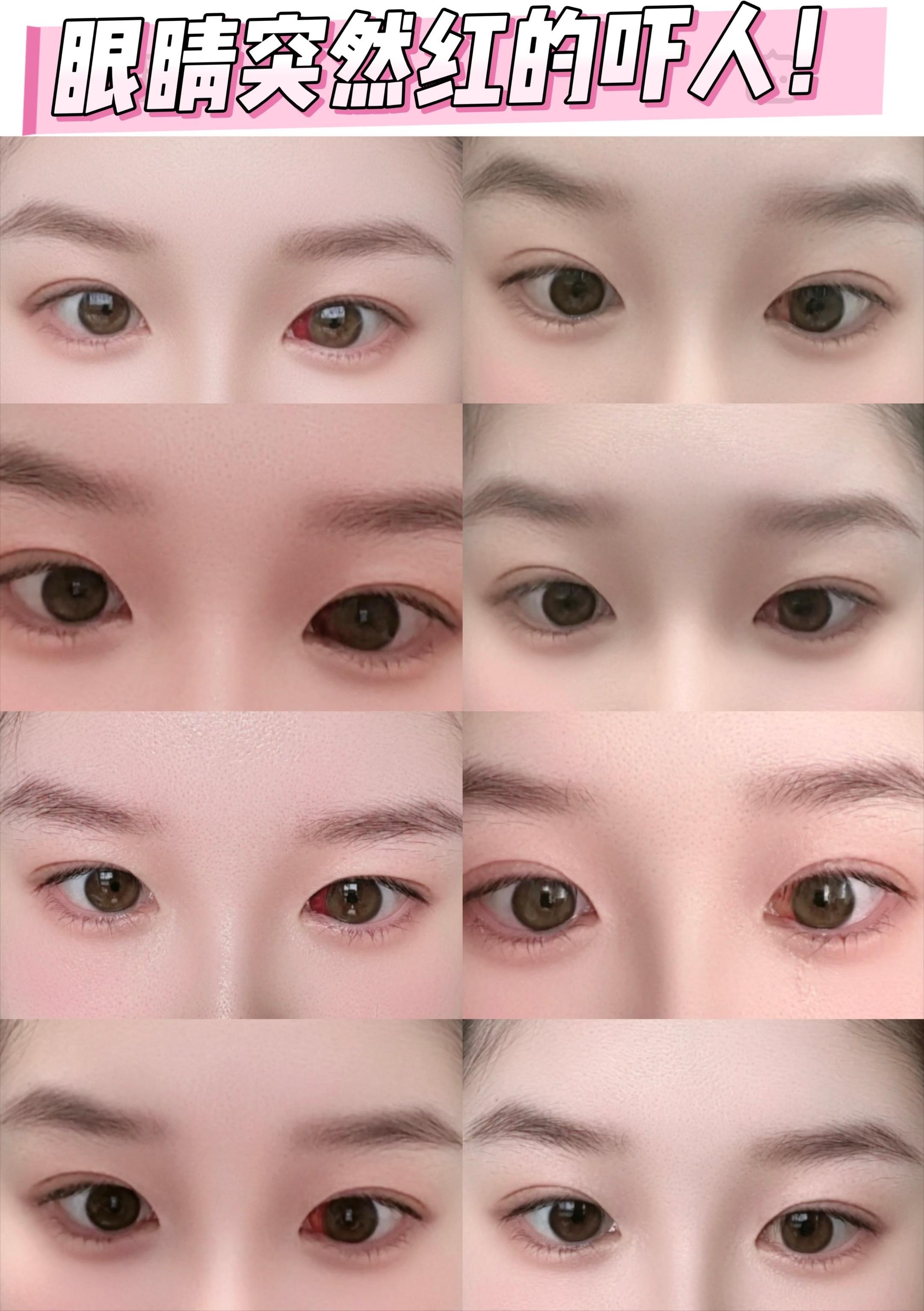 😱眼球爆“血球”！我没去医院10天自救。姐妹们！我真的要被自己吓死了...