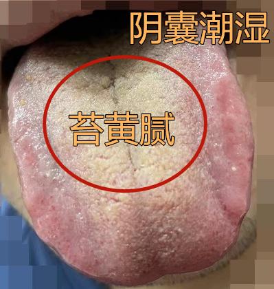 四五年的手艺大师，时间短，阴囊潮湿，服用很多药补肾，但却一点效果都没有。
 
患
