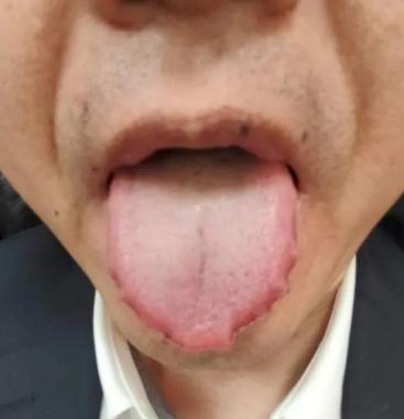 这种齿痕舌，健脾祛湿已经“无力回天”！

很多人看到舌边有齿痕，第一反应就是 “