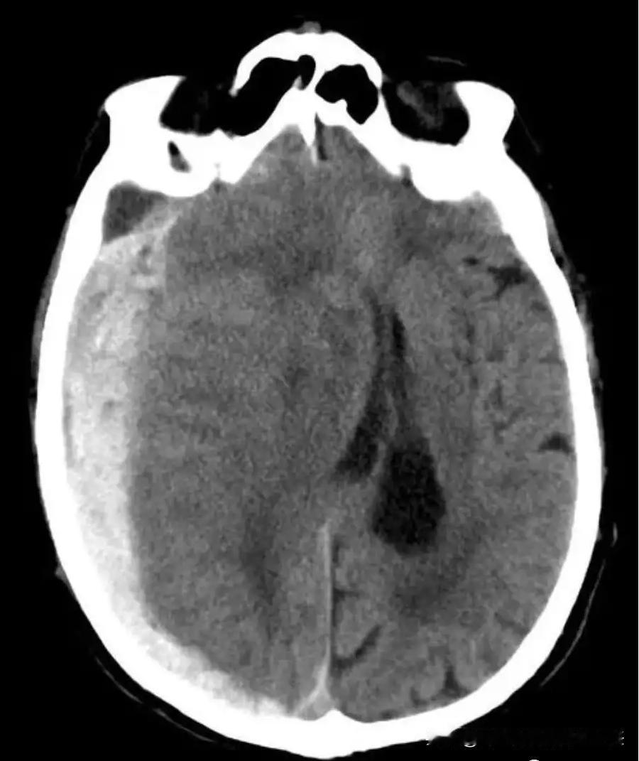 脑出血后的脑疝是怎么形成的？为什么大家那么紧张

 
脑出血后，由于血肿的占位效