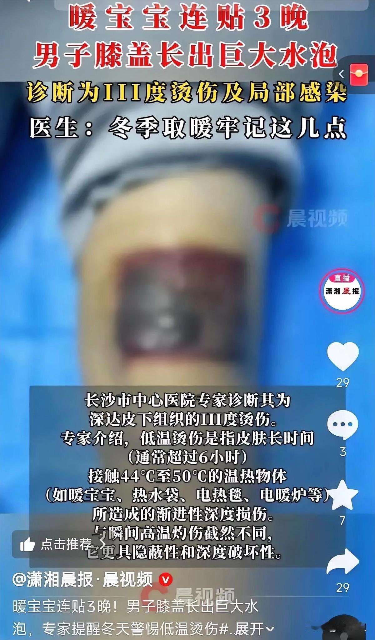 湖南长沙一男子膝盖疼，为了缓解，直接在膝盖处贴了暖宝宝，贴了一晚后感觉没那么疼了