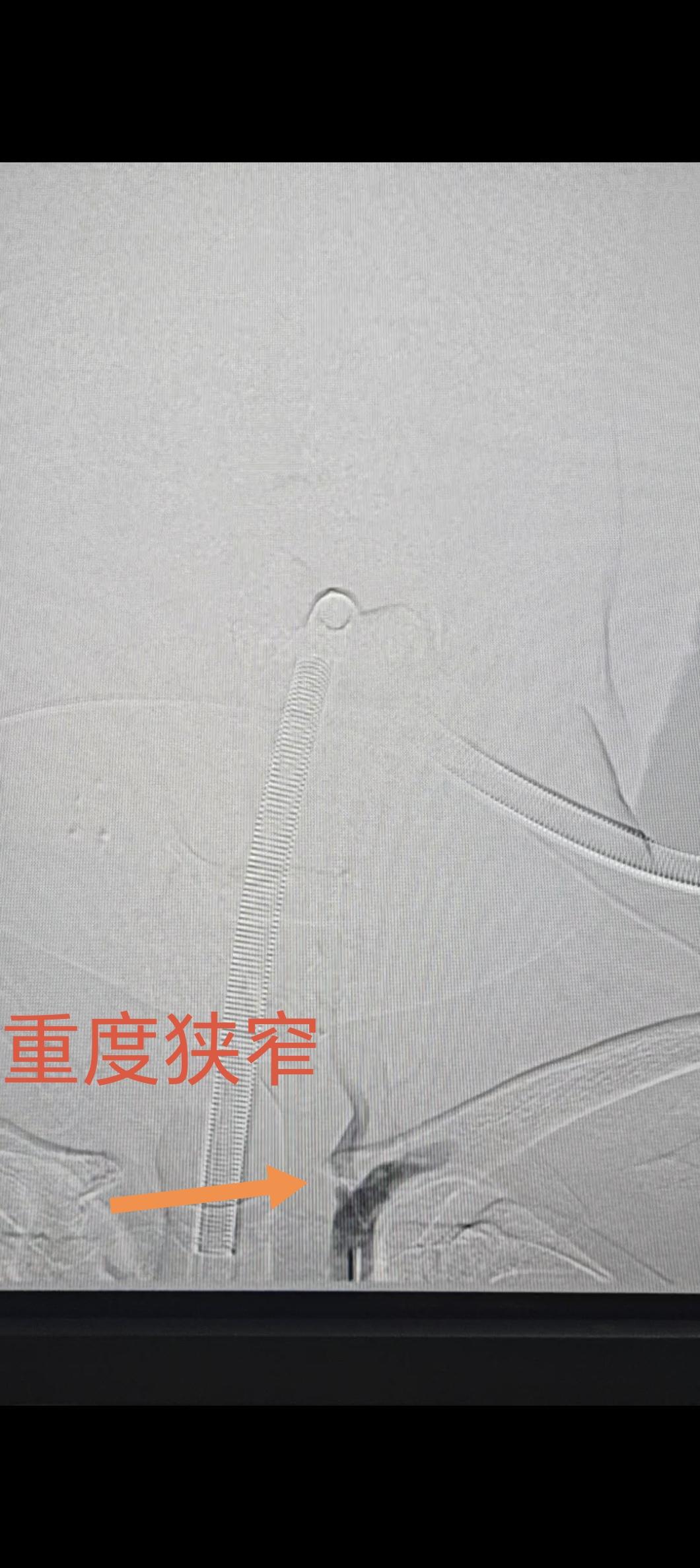 医学的魅力，往往在于那些“不得不成功”的时刻。 今天处理了一例特殊的椎...