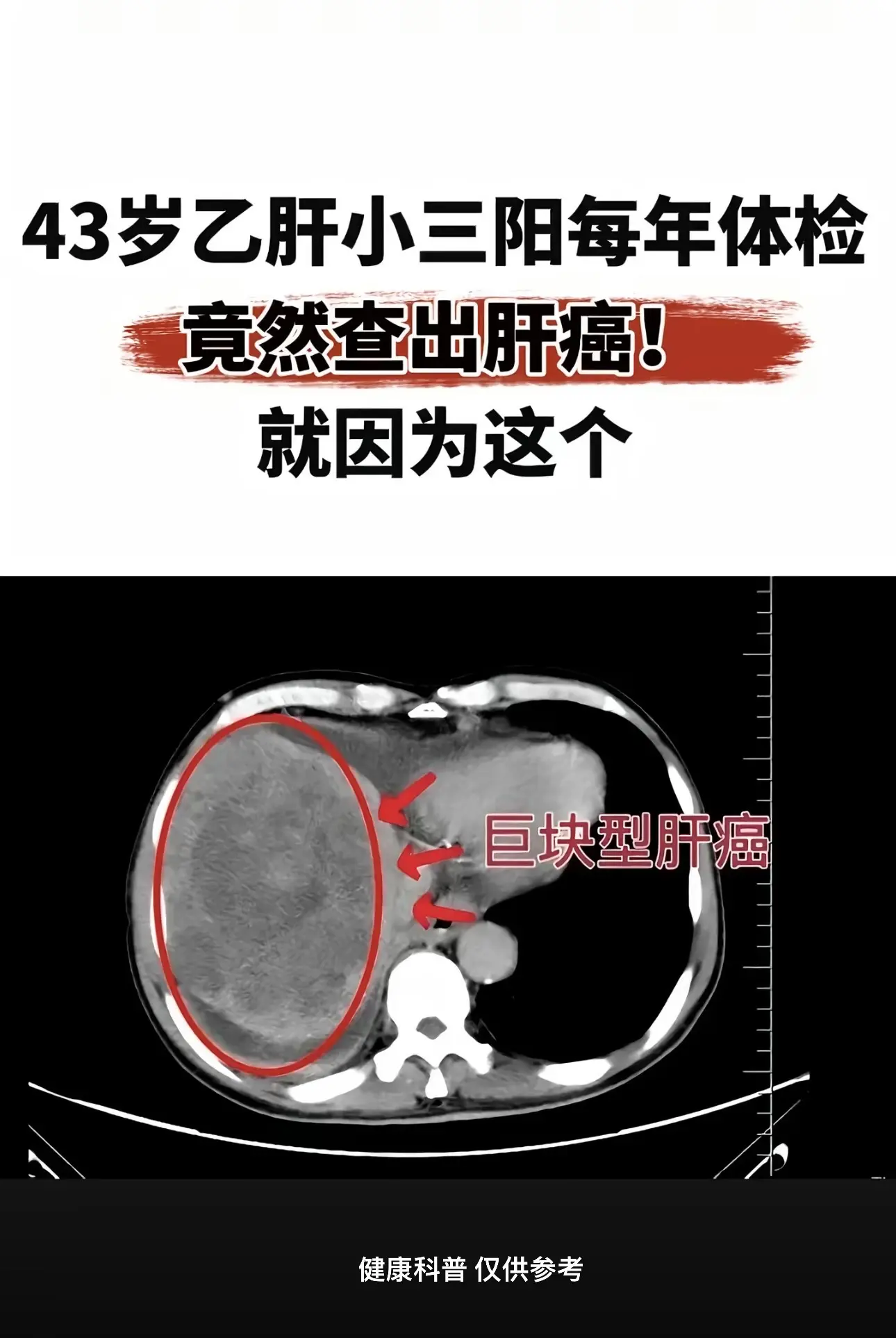 乙肝小三阳每年体检，竟然查出肝癌！临沂的一个病号，这个病号也是很可惜很...