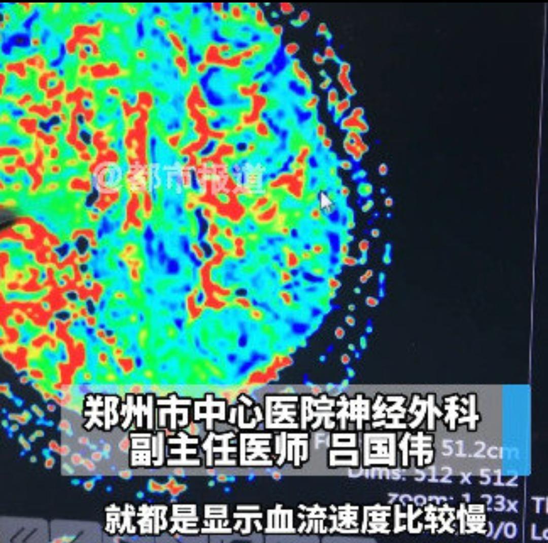 女孩贪玩忘事成绩下滑查出罕见病，真相看哭无数家长
 
孩子成绩突然变差、总忘事，