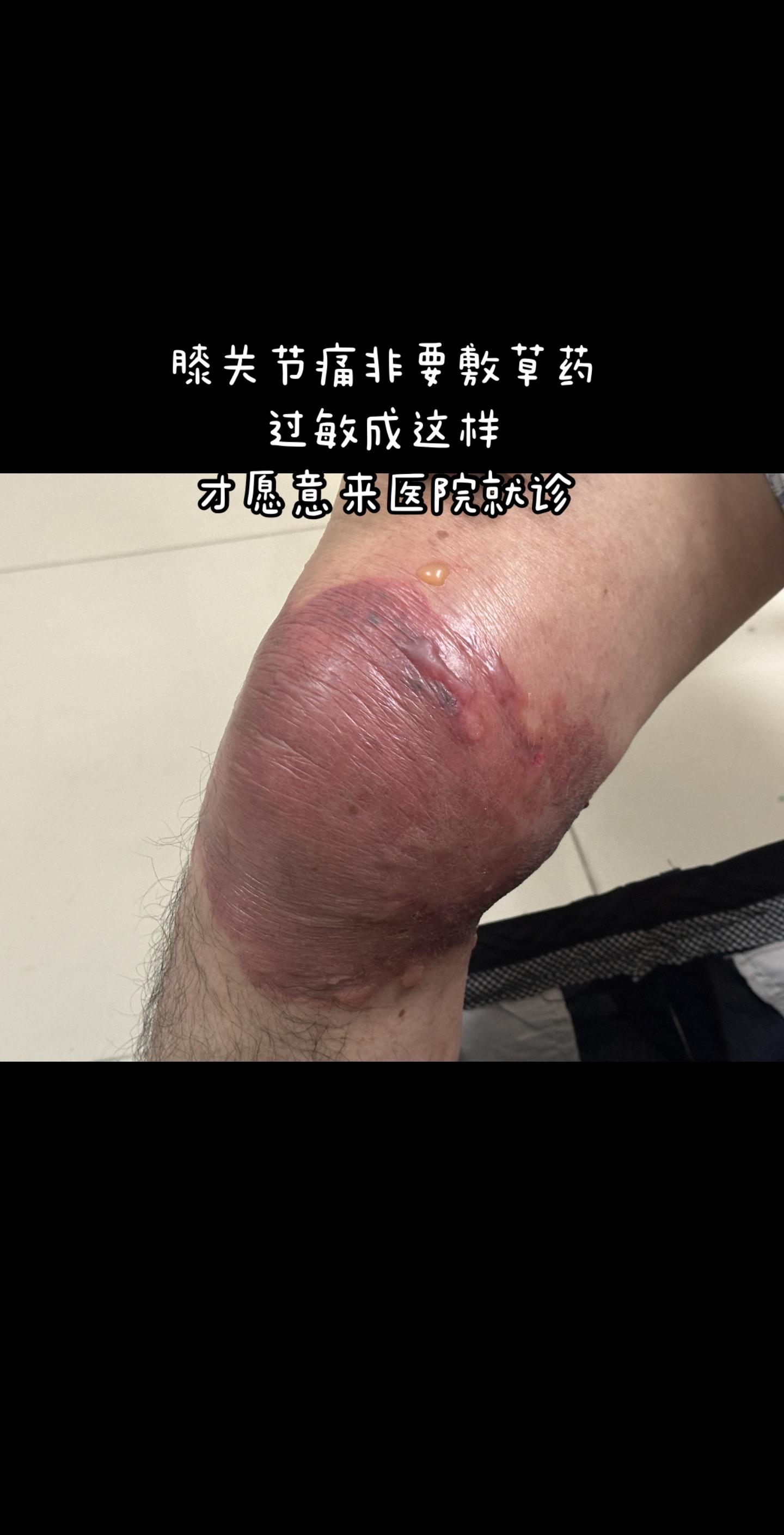 关节痛别再随便敷草药了 关节痛别乱服草药