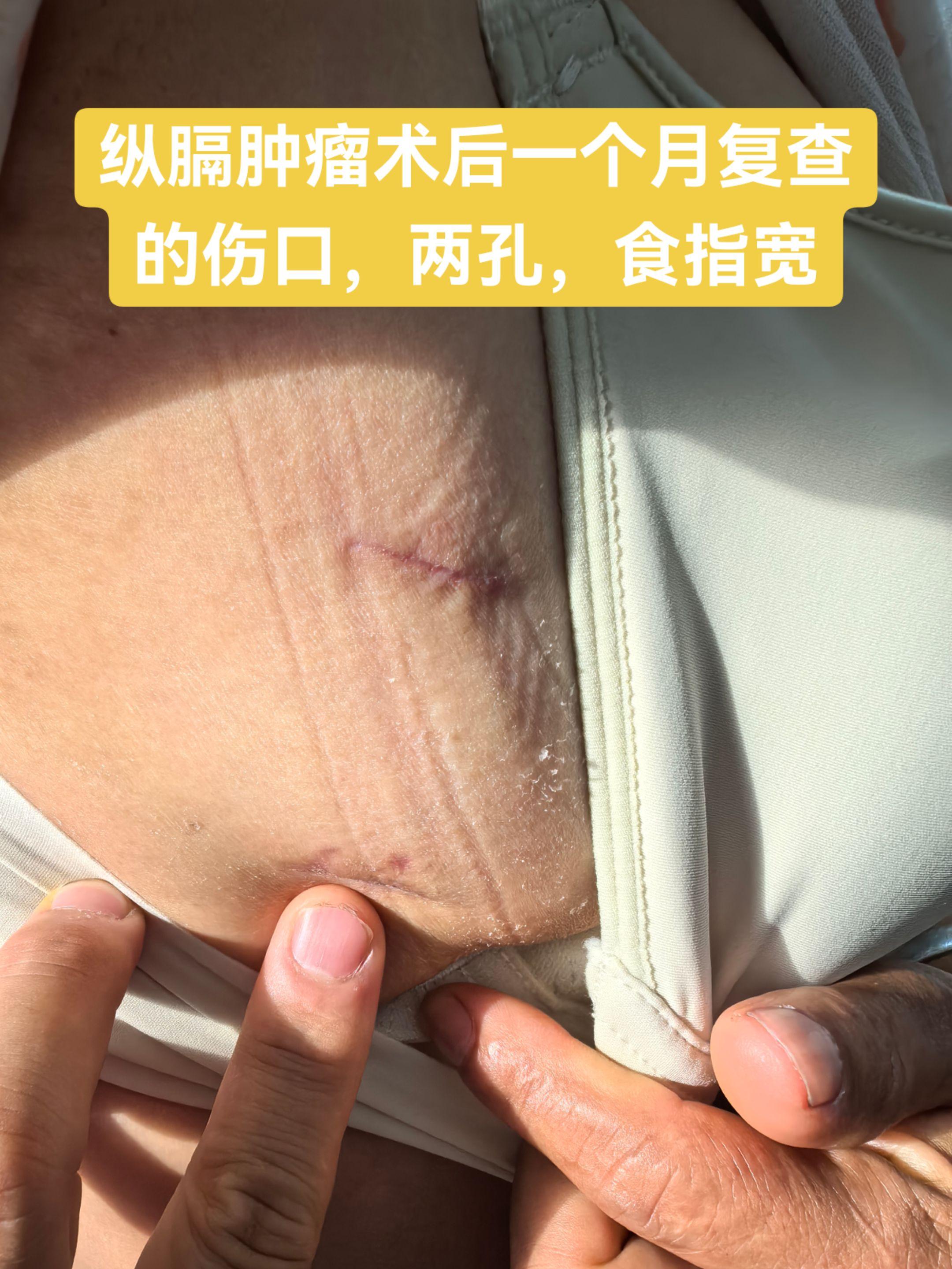 纵膈肿瘤术后一个月复查的伤口，两孔，食指宽胸外科