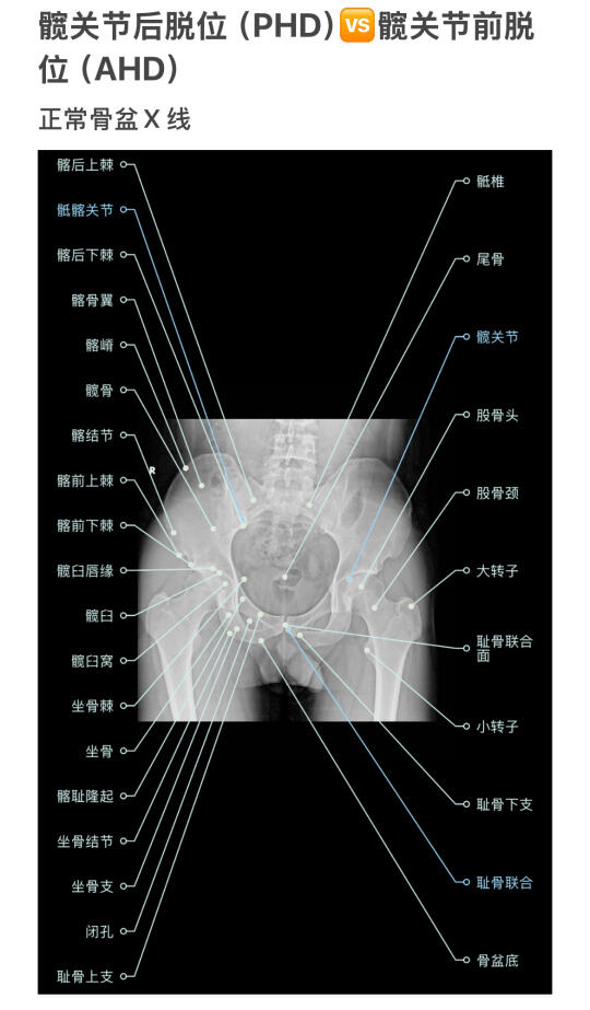 髋关节前后脱位快速鉴别