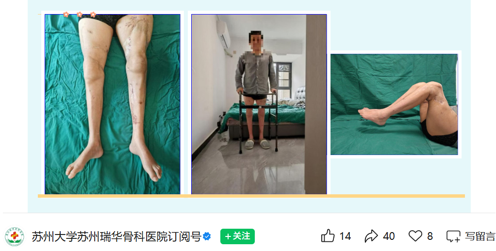 世界首例双大腿再植成功 看到这条新闻，眼眶一热。51岁的工人，双大腿被机器完全绞