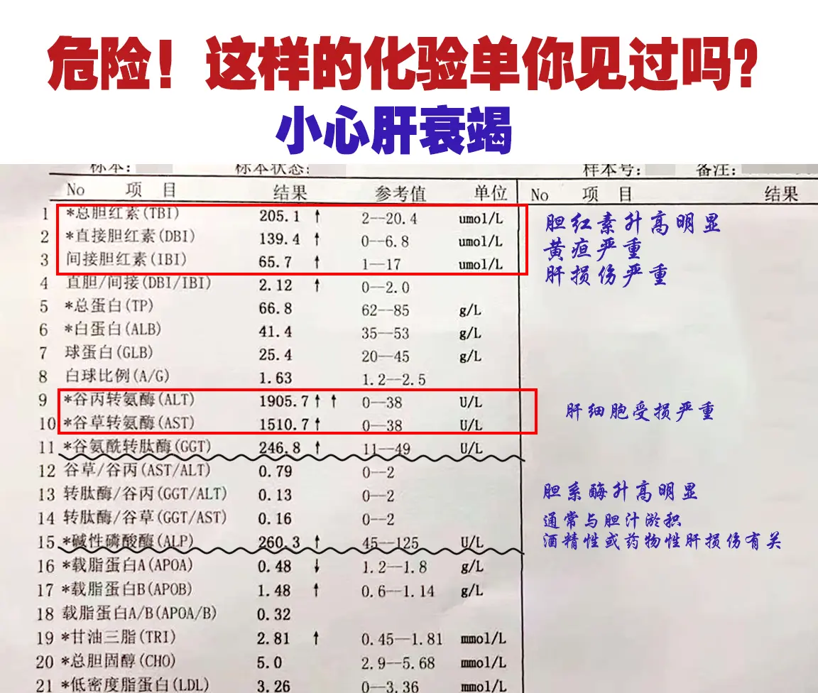 这是一位济南本地的患者，54岁，来的时候整个人都黄了，皮肤、巩膜黄染的...