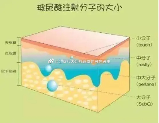 玻尿酸填充的持久性因个体差异而异，通常可持续几个月至一年左右。定期维护对于保持理