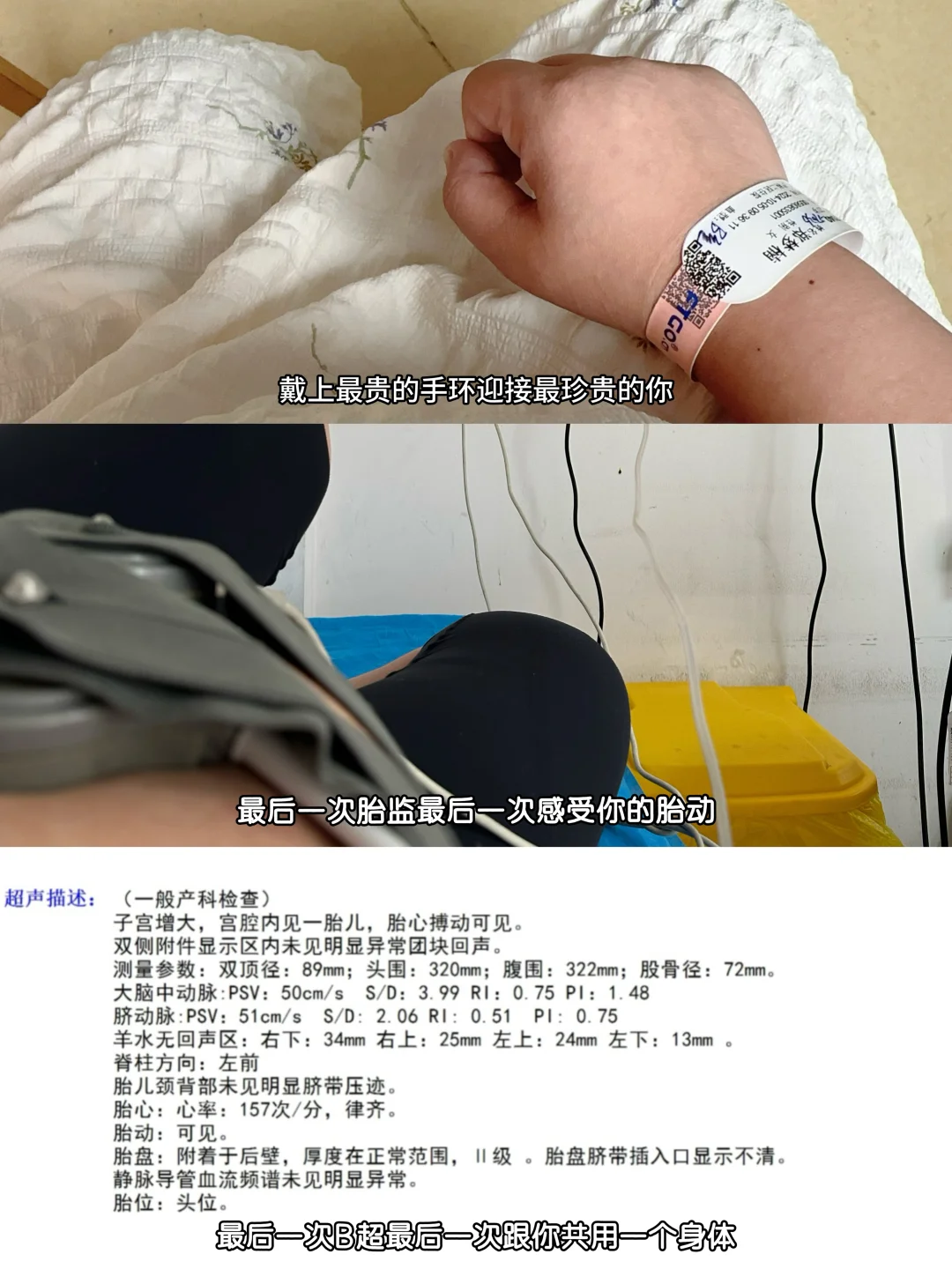我的剖腹产日记 | 37w+1轻度子痫