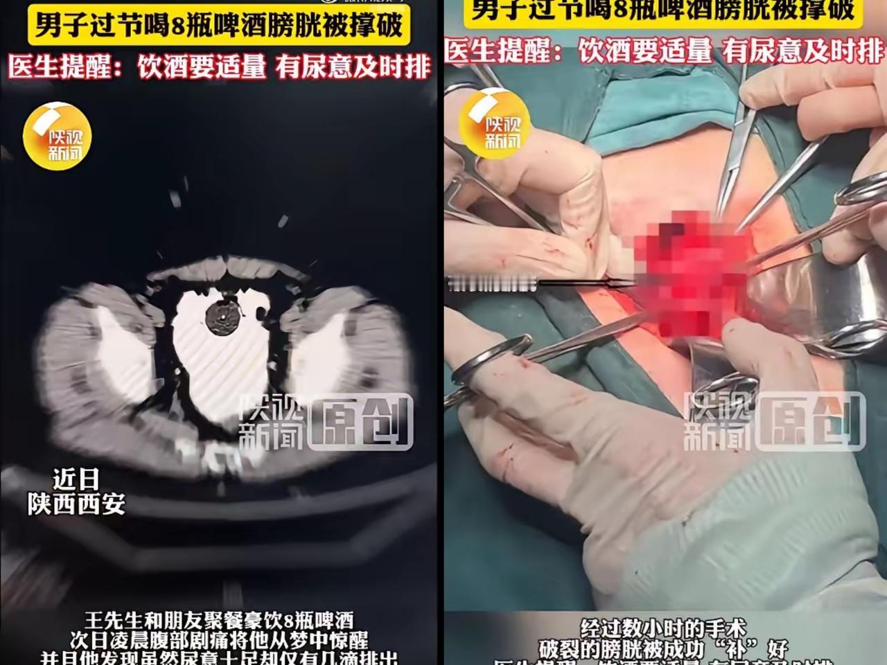 喝8瓶啤酒没上厕所，膀胱直接裂个6cm大洞！这习惯你可能也有
 
谁能想到，喝顿
