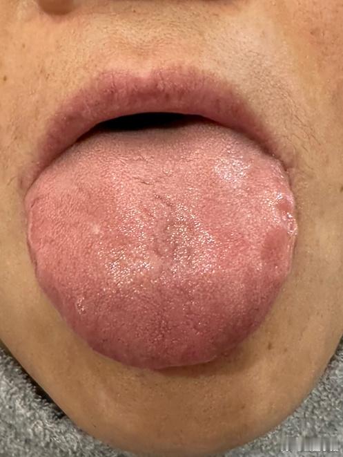 这个同学舌红胖大齿痕，腹胀满腿微肿，脾实肝郁而化热，脾实指吸收了过多水湿，邪气为