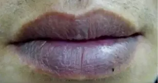 嘴唇发紫就是心脏不好吗？先别急，更重要的是看这一点
