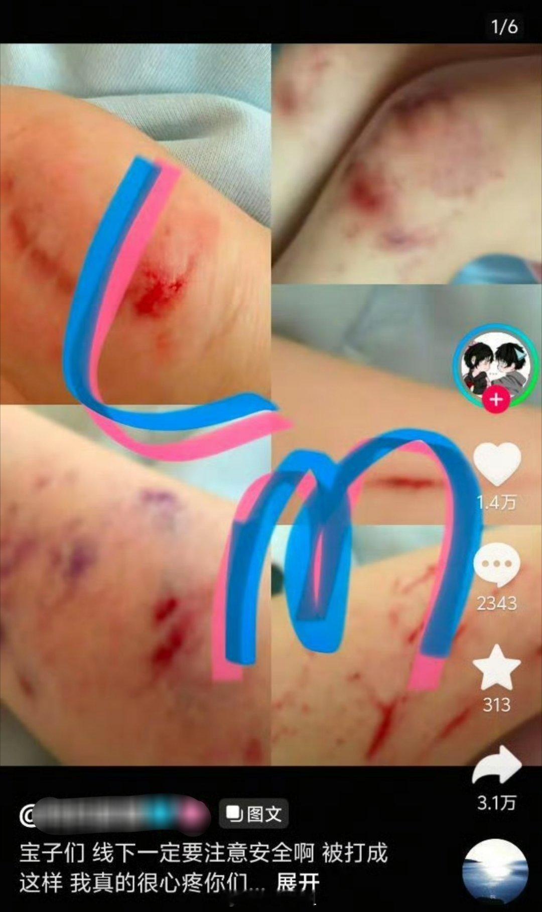 我的天啊，王橹杰跟穆祉丞的CP粉好像在线下被打了，打的青一块紫一块的，都淤青了，