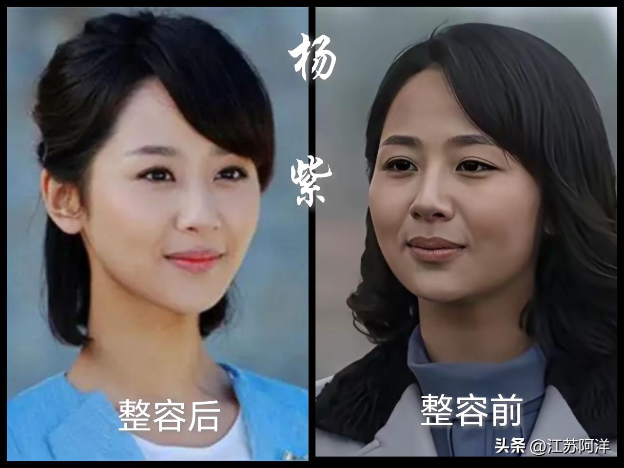 杨紫坦承整容
    整容前面颊饱满，下颌线条圆润，全脸视觉上更宽。
    整