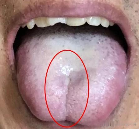 最大的病，还是痰瘀！中医教你1招，疏肝理气，化痰散结
这个粉丝他说前段时间熬夜的