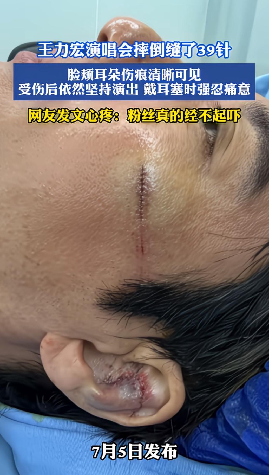 王力宏演唱会摔倒，结束后去缝针，细细密密的针脚居然有39针，明星的医生医术也太牛