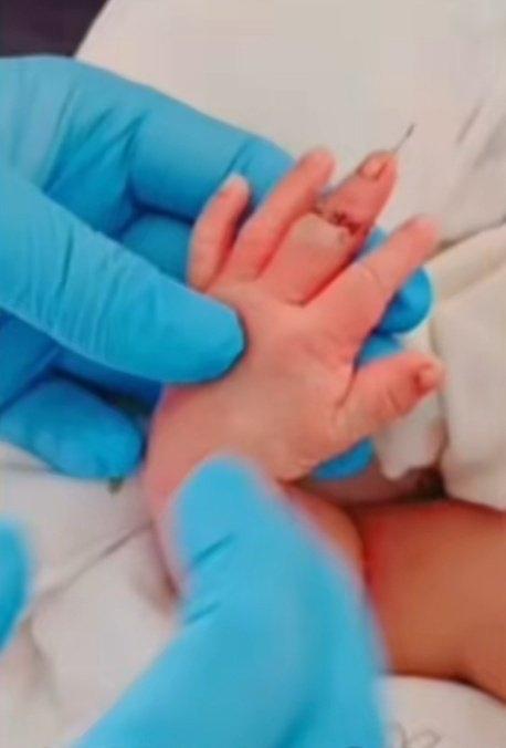 刚降临人世的宝宝，本该被小心翼翼呵护，却在医院手术台上遭了无妄之灾——手指被助产