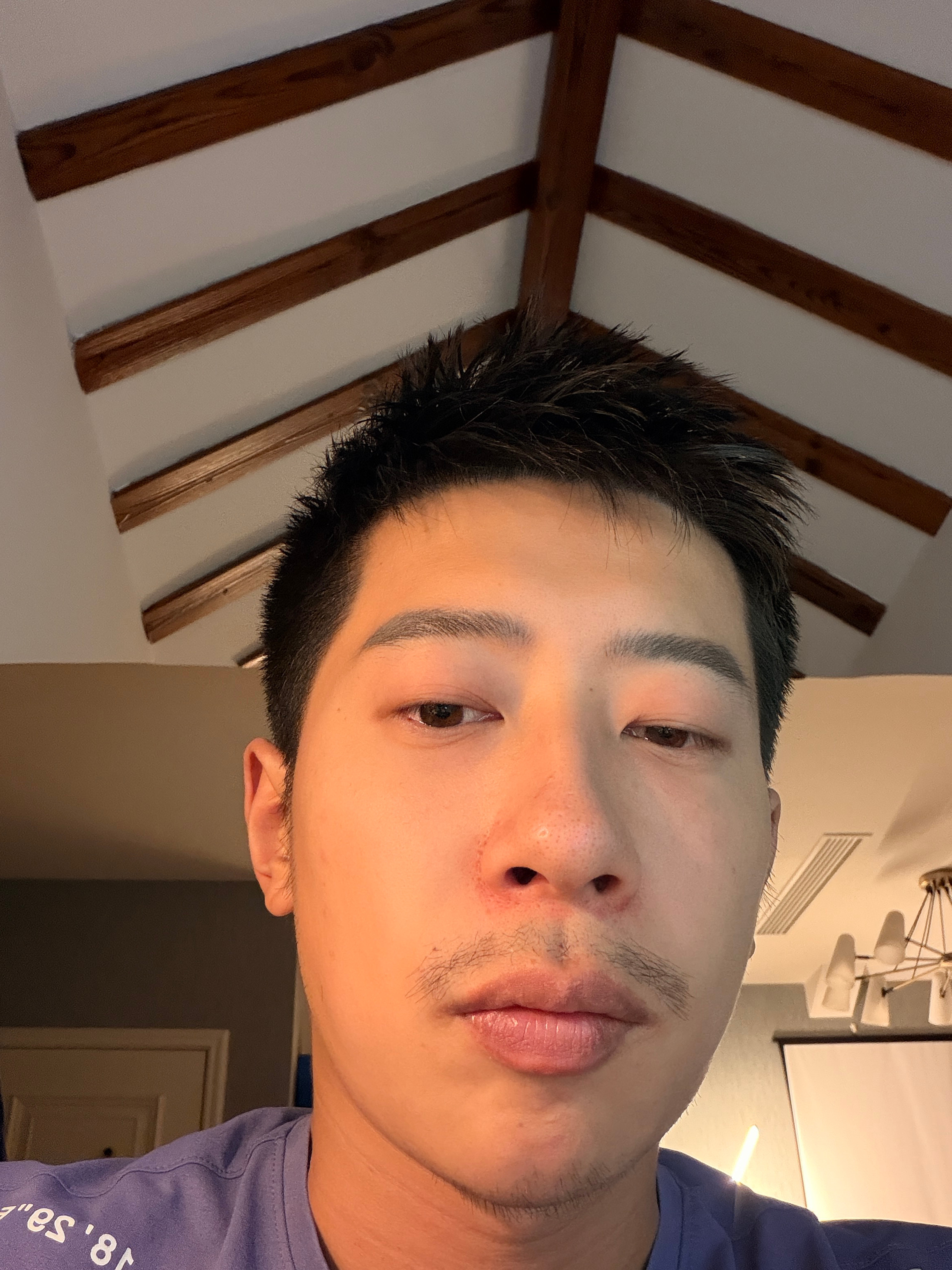 周一右眼过敏，周二野生虫子飞进左眼搞成结膜炎了