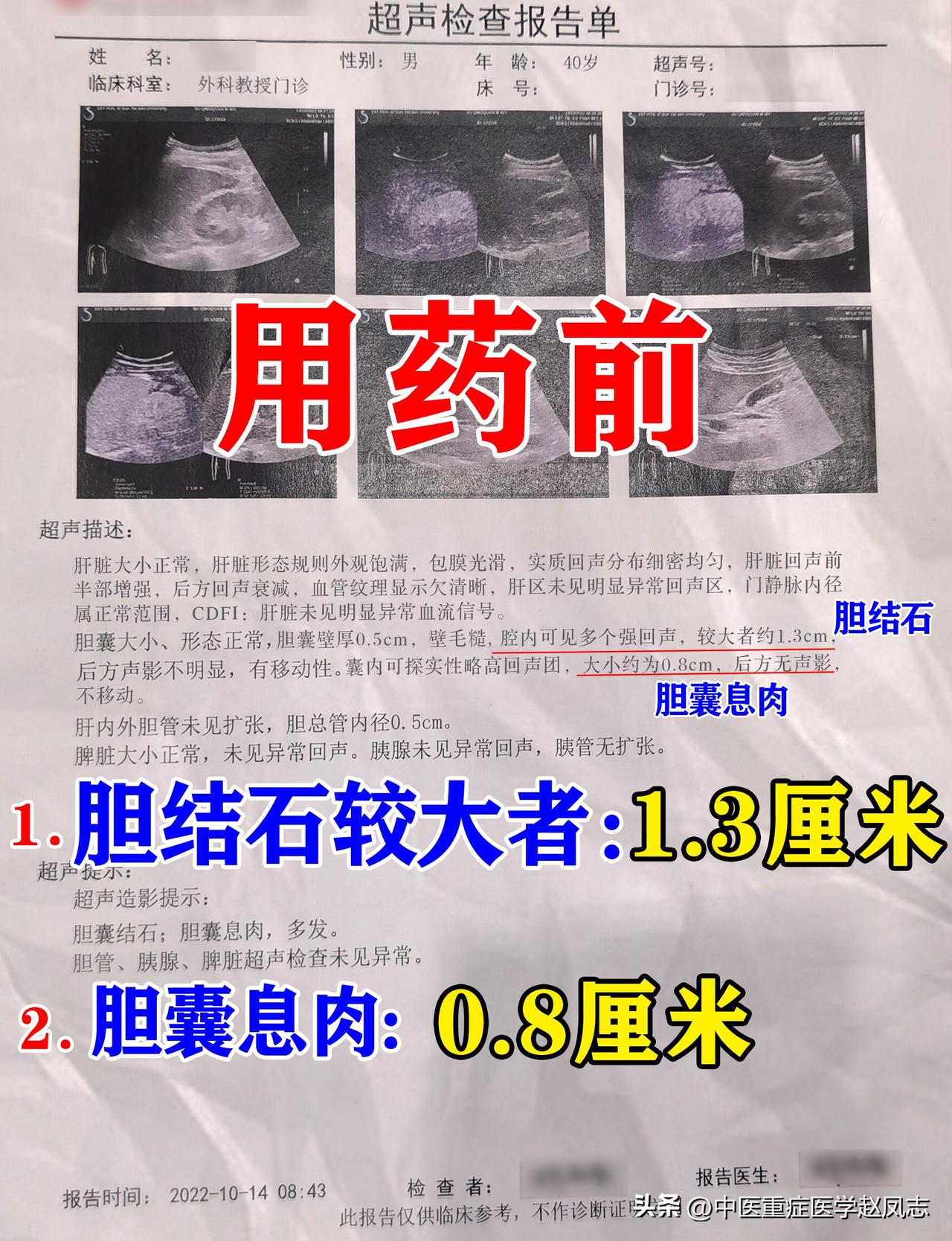 这位患者是因为右上腹经常疼痛，去医院做检查显示有，胆结石、胆囊息肉，当时情况是胆
