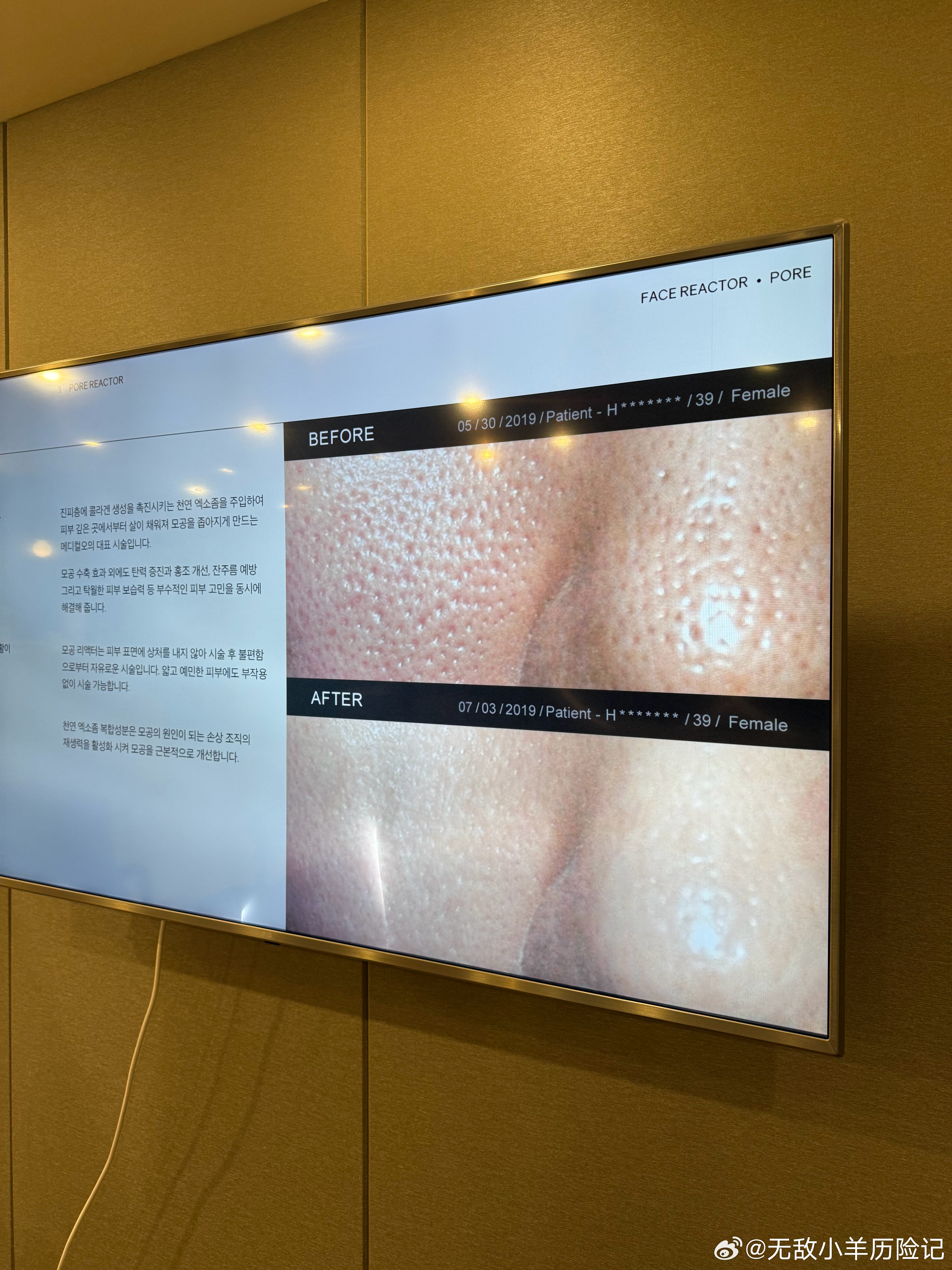 上次去韩国弄了魅丽可傲那个毛孔针现在也快一个月了，来汇报一下！像我是全脸皮肤除了