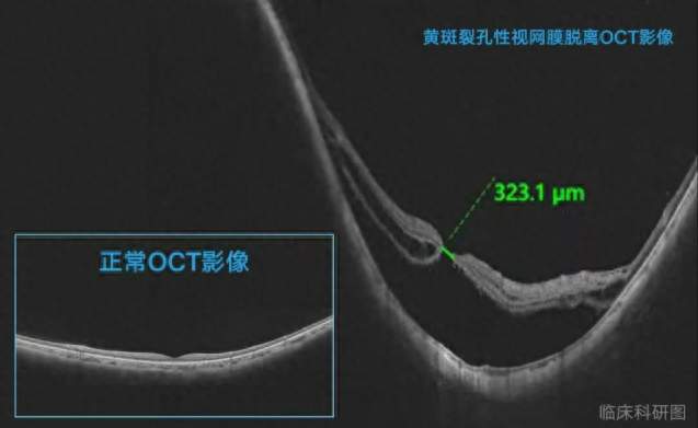 高度近视牵出“眼底危情”，泉州三名市民均被确诊断黄斑裂孔性视网膜脱离