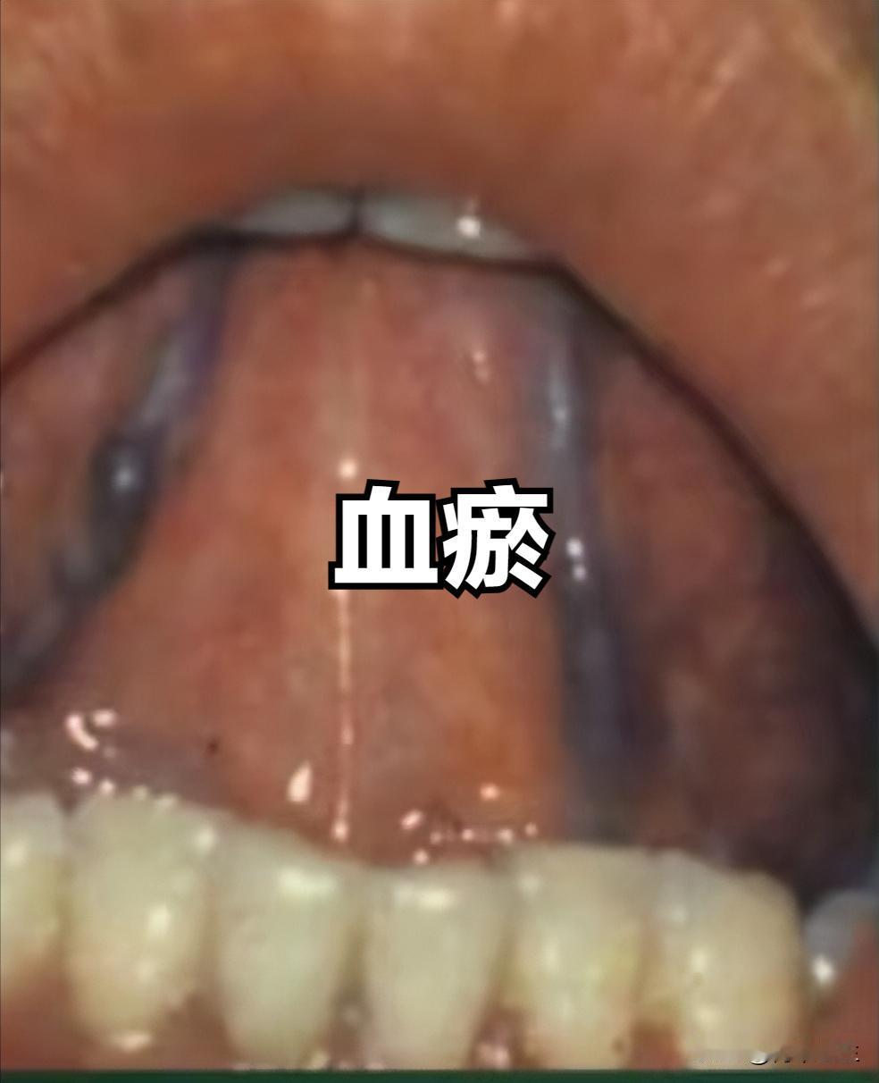 你的体质是血虚还是血瘀？看舌下的这个 小青筋就知道了，何医生教大家怎么分辨体质
