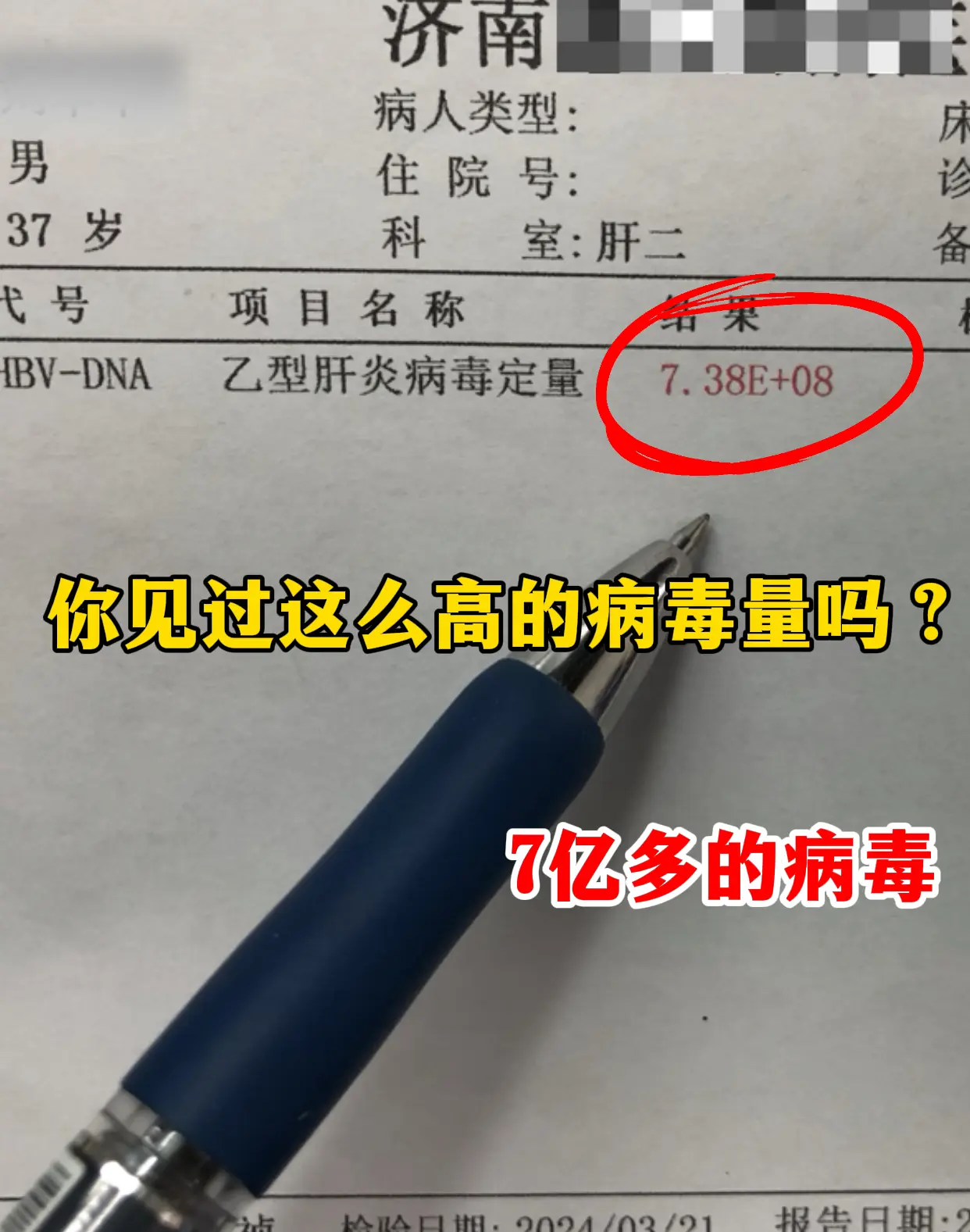 今天门诊碰到个山东本地的乙肝大三阳患者，说最近总觉得没劲儿、吃啥都恶心...