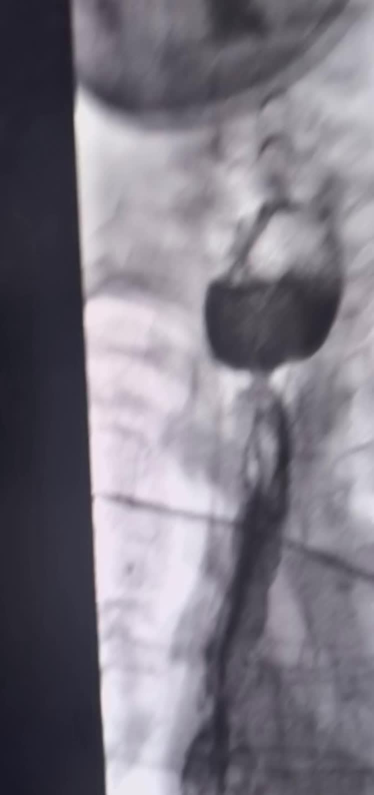 上午一台食管癌术后吻合口狭窄球囊扩张成型 上午一台食管癌术后吻合口狭窄...