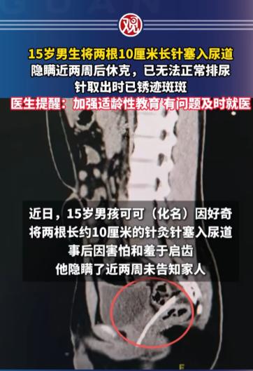 江苏，一男生为了追求刺激，把两根长达10厘米的针灸针塞进尿道里，然后取不出来，可