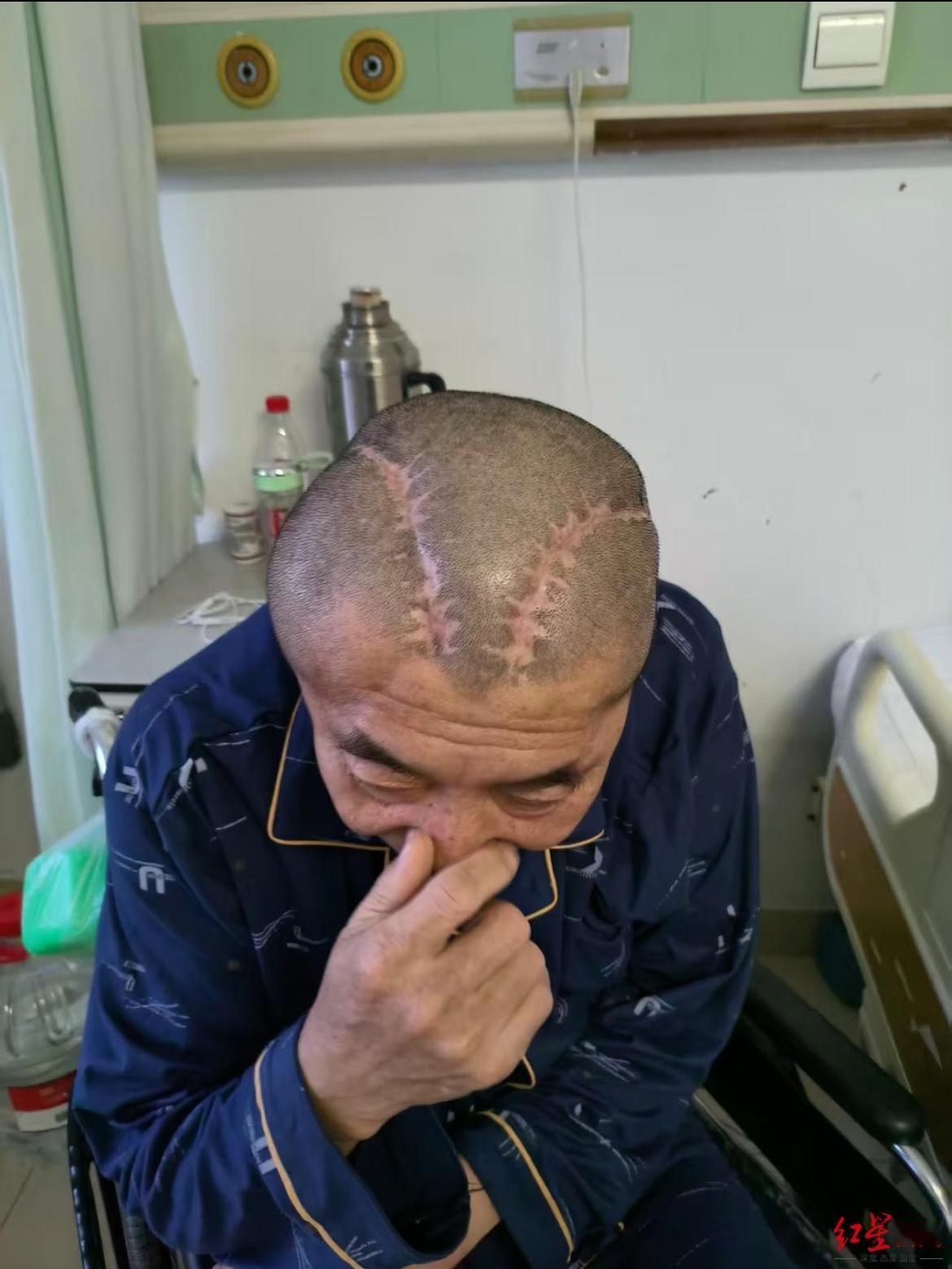 “太离谱！右脑出血被错开左脑。”包头王先生右脑出血送医手术，本该精准开颅救命结果