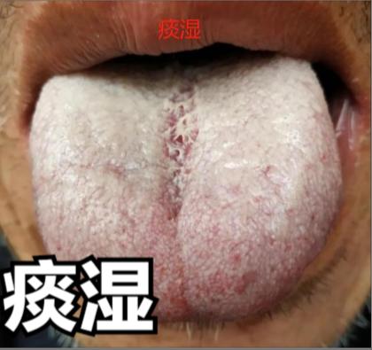 湿不除，百病出！痰湿用二陈，湿热用茵陈篙汤；寒湿用真武汤，教你如何通过舌象，将身